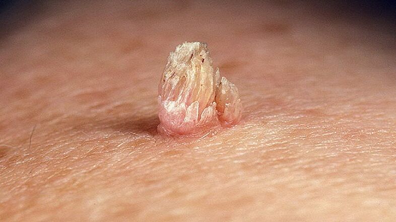 genital papilloma in the body