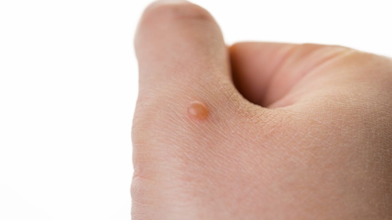 Neophage in the arm