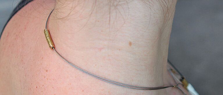 Papilloma in the neck
