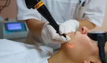 An effective procedure to remove papilloma on the face with a laser