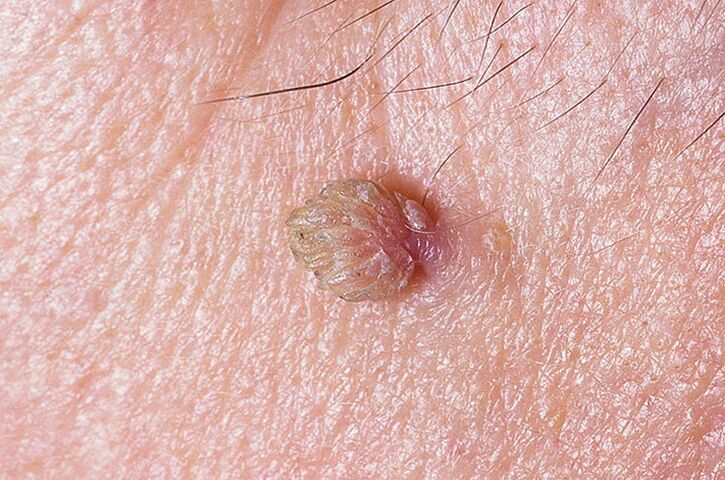 A skin wart that can be removed in several ways