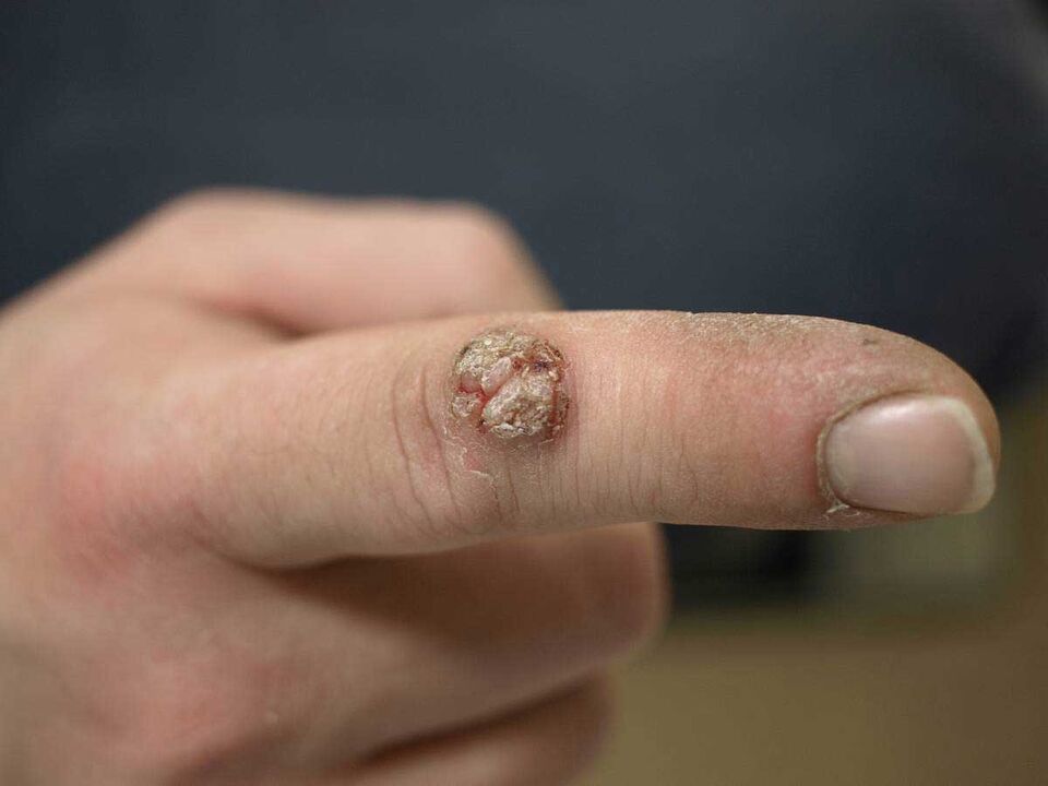 Large wart on a finger that requires removal