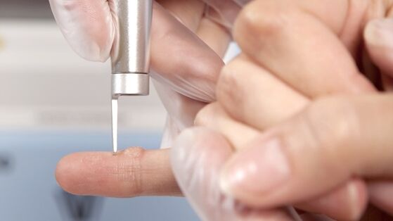 One of the methods for removing warts is the use of laser