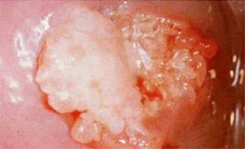 Cervical candy