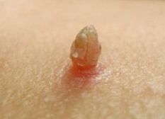 Clear papilloma