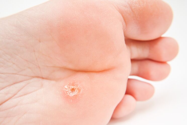 Unique warts