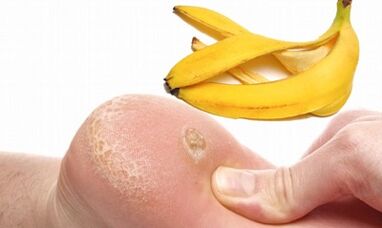 Banana bark for the treatment of a plantar wart