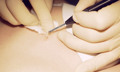 Surgical removal of plantar wart
