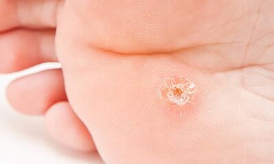 Why the plantar warts appear