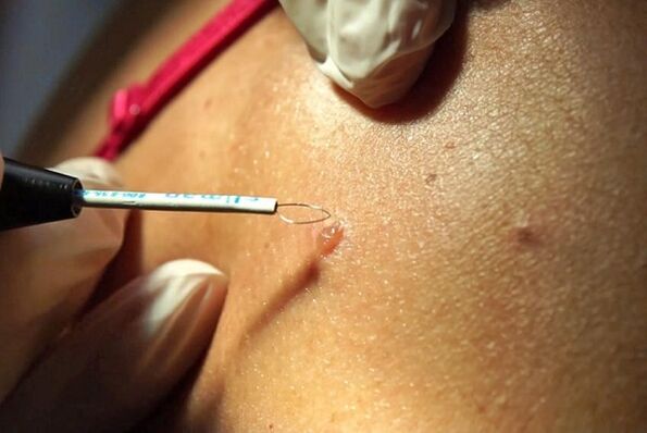 Removal of papillomas by radio wave method