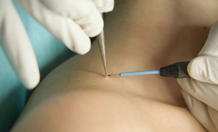 use of radio wave therapy