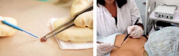 electrocoagulation as a way to remove papillomas