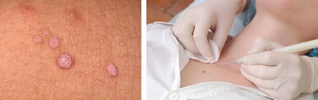 professional removal of papillomas on the body