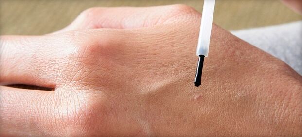 wart treatment with medication