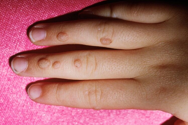 vulgar warts on fingers