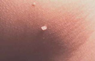 Papilloma on the skin