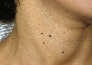 Papillomas on the neck