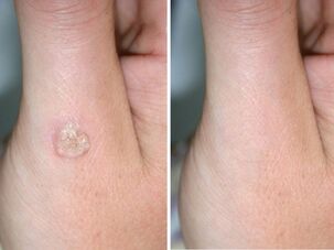 Wart before and after removal